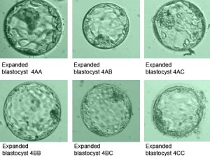 Process of Blastocyst Embryo Transfer